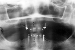 Root canals