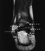 Ankle MRI artifacts