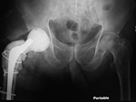 Antibiotic femoral prosthesis