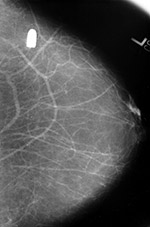 Bullet in breast on mammography