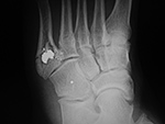 Bullet in foot