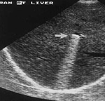 Bullet in liver