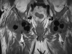 Hip antibiotic beads MRI coronal T1 image
