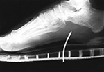 Nail in foot