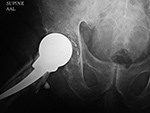 Retained surgical sponge