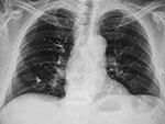 Vertebroplasty complication