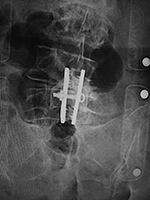 X-Stop device