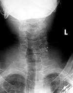 Vagus nerve stimulator AP view