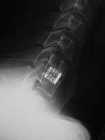 Cervical spine vertebral cage