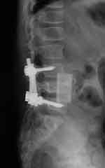 Lumbar spine bony disk strut