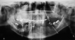 Mandibular wiring