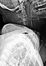 Nasogastric and endotracheal tubes