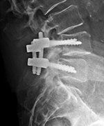 PLIF lateral view