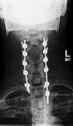 Posterior spinal fusion AP view