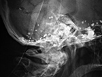 Pantopaque in the skull