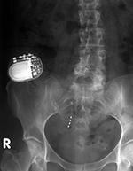 Sacral stimulator