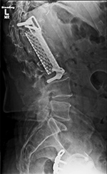 Thoracic vertebral corpectomy with vertebral cage and left lateral sideplate