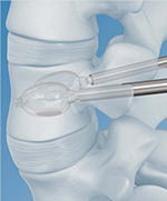 Vertebral Balloon Augmentation System (kyphoplasty)