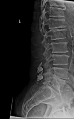 Lateral view X-Stop device