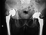 Osteolysis and particle disease in right hiip implant