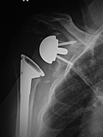 Reverse total shoulder arthroplasty posterior dislocation