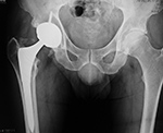 Right hip metal-on-metal hip prosthesis