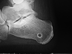 Calcaneal ghost track