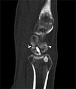 Scaphoid fracture