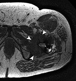 Pseudotumor