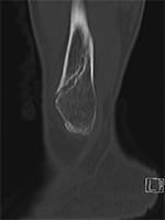 Fracture union